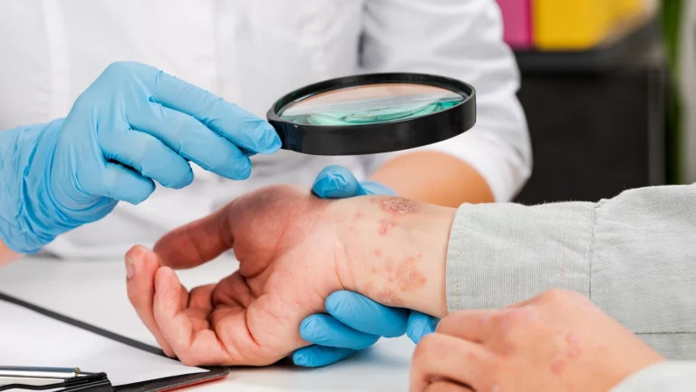 Psoriasis